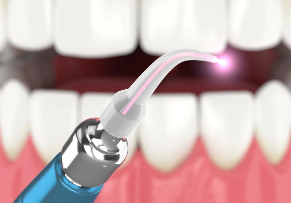 laser dentaire dentiste cavalaire - saint-tropez